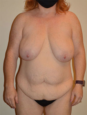Breast Lift Case 15010 Before Photo Breast Lift