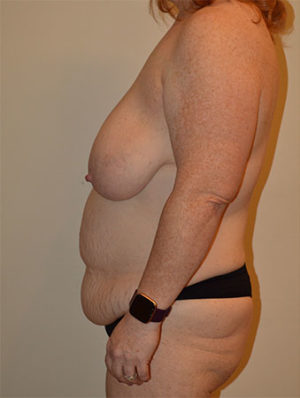 Breast Lift Case 15010 Before Photo Breast Lift