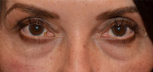 Eyelid Surgery Case 15000 Before Photo Eyelid Surgery