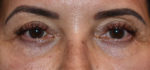 Eyelid Surgery