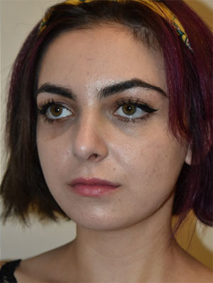 Nose Surgery Case 15003 After Photo Nose Surgery