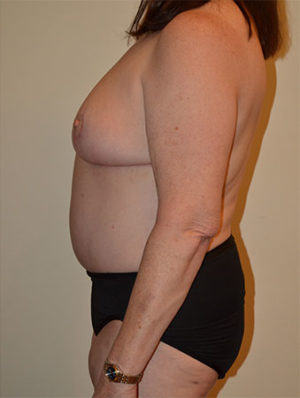 Breast Reduction Case 15024 After Photo Breast Reduction