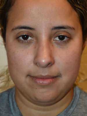 Nose Surgery Case 15067 After Photo Nose Surgery