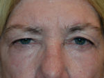 Eyelid Surgery