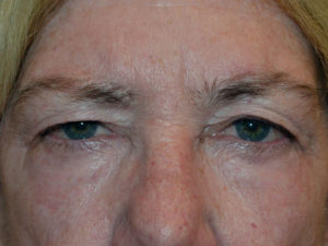 Eyelid Surgery Case 15068 Before Photo Eyelid Surgery