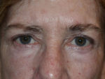 Eyelid Surgery