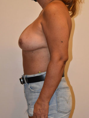 Breast Lift Case 15069 After Photo Breast Lift