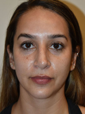 Nose Surgery Case 15070 Before Photo Nose Surgery