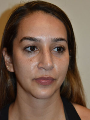 Nose Surgery Case 15070 Before Photo Nose Surgery