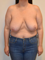 Breast Reduction