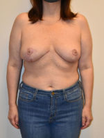 Breast Reduction