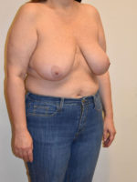 Breast Reduction