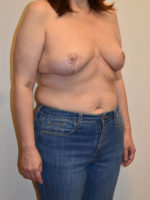 Breast Reduction