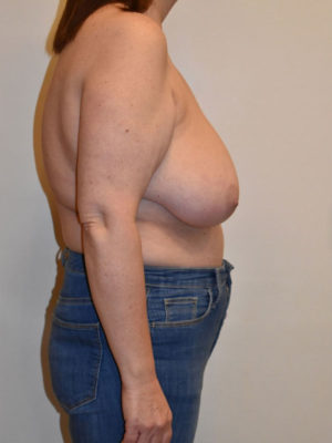 Breast Reduction Case 15073 Before Photo Breast Reduction