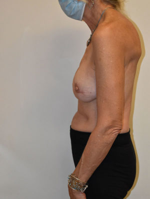 Breast Reconstruction Case 15074 After Photo Breast Reconstruction