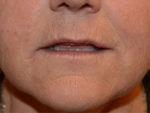 Facial Fat Grafting
