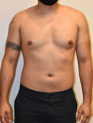 Gynecomastia Case 15071 Before Photo Gynecomastia