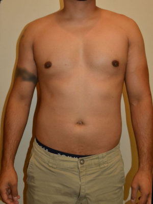 Gynecomastia