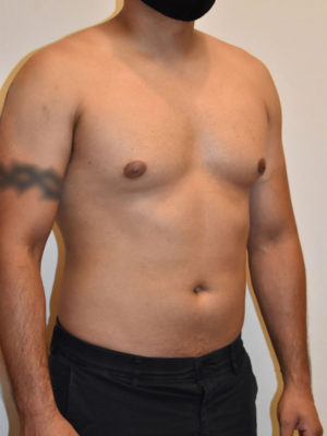 Gynecomastia Case 15071 Before Photo Gynecomastia