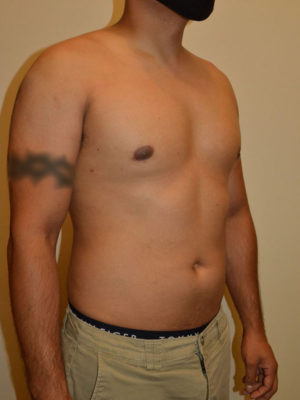 Gynecomastia Case 15071 After Photo Gynecomastia