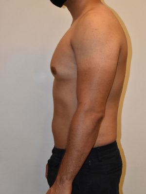 Gynecomastia Case 15071 Before Photo Gynecomastia