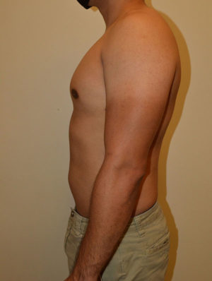 Gynecomastia Case 15071 After Photo Gynecomastia