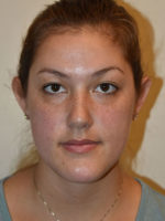 Otoplasty
