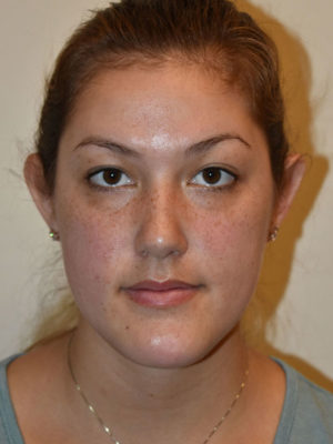 Otoplasty Case 15142 Before Photo Otoplasty