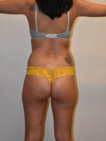 Buttock Augmentation