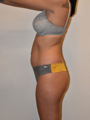 Buttock Augmentation Case 15144 Before Photo Buttock Augmentation