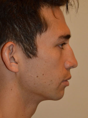 Chin Implants Case 15146 Before Photo Chin Implants