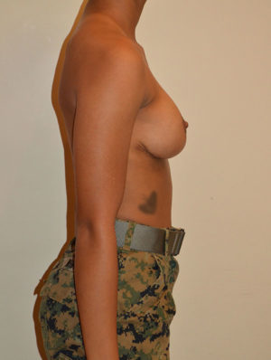 Breast Reduction Case 15147 After Photo Breast Reduction