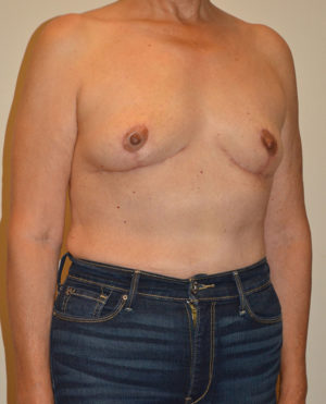 Breast Lift Case 15190 After Photo Breast Lift