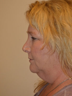 Neck Liposuction Case 15191 Before Photo Neck Liposuction