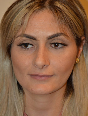 Nose Surgery Case 15193 Before Photo Nose Surgery