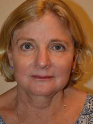 Facelift and Necklift