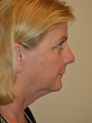 Facelift and Necklift