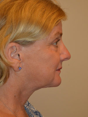 Facelift and Necklift