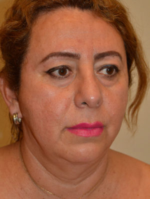 Facial Feminization Case 15264 After Photo Facial Feminization