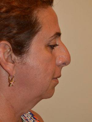 Facial Feminization Case 15264 Before Photo Facial Feminization