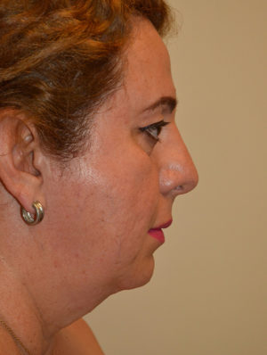 Facial Feminization Case 15264 After Photo Facial Feminization