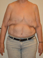 Breast Reconstruction