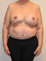 Breast Reconstruction