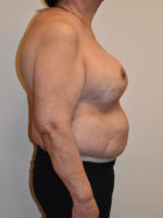 Breast Reconstruction