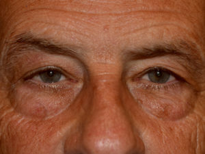 Eyelid Surgery Case 15376 Before Photo Eyelid Surgery