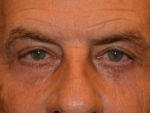 Eyelid Surgery