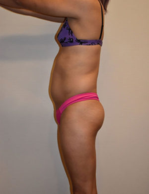 Body Feminization Case 15386 Before Photo Body Feminization