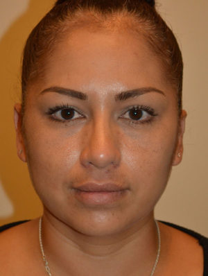 Nose Surgery Case 15385 After Photo Nose Surgery