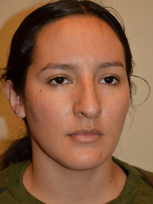 Nose Surgery Case 15461 Before Photo Nose Surgery