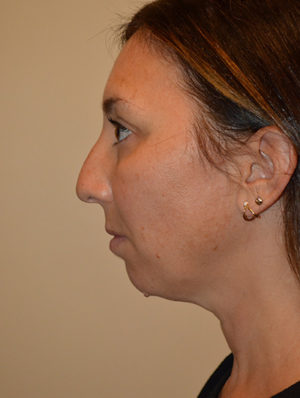 Chin Implants Case 15431 Before Photo Chin Implants